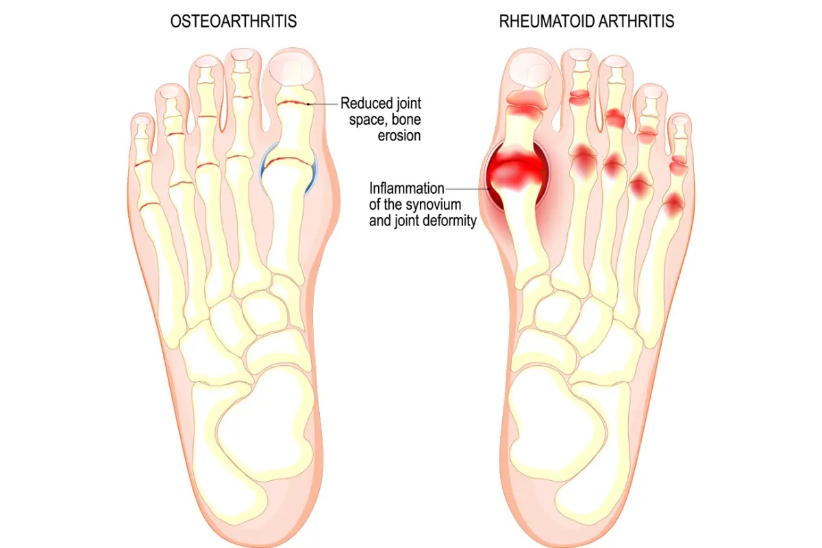 Big toe joint arthritis