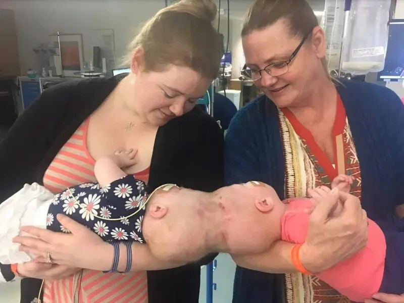 Siamese twin sisters were born with their heads joined, but at 1 year old doctors separated them: Here’s what the girls look like