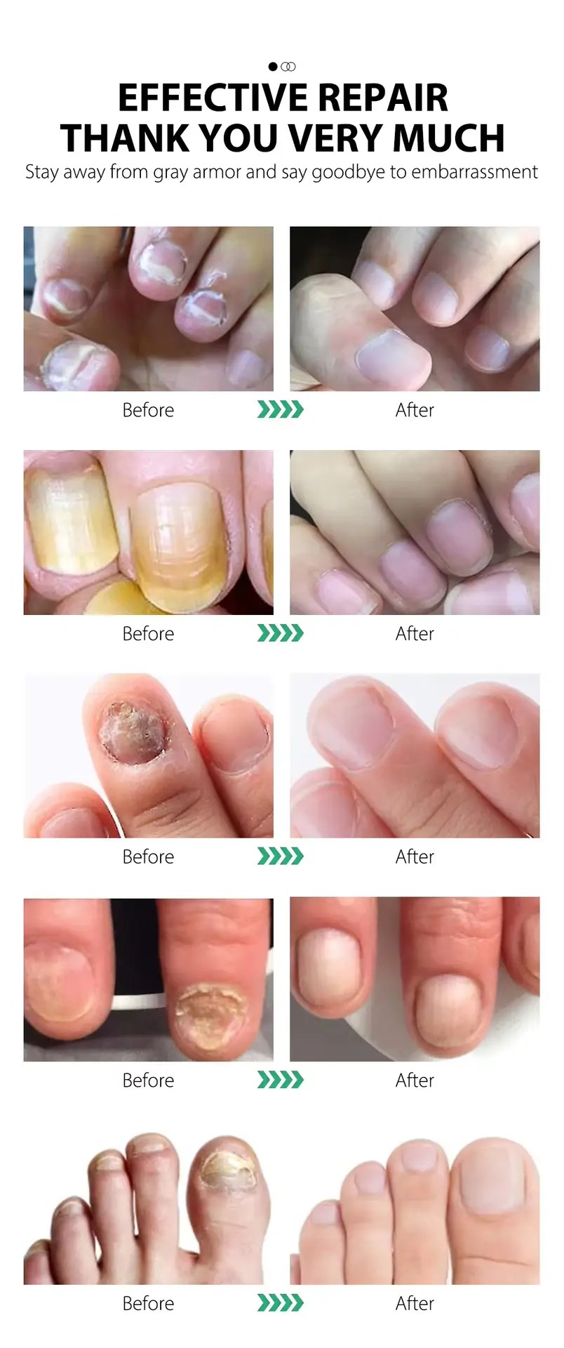 Nail Fungus Treatment| Effective Nail Solution| Fingernail Fungus| Nail Health Solution| Fungus Treatment for Nails| Nail Care Products| Anti-Fungal Nail Solution| Nail Fungus Remover
