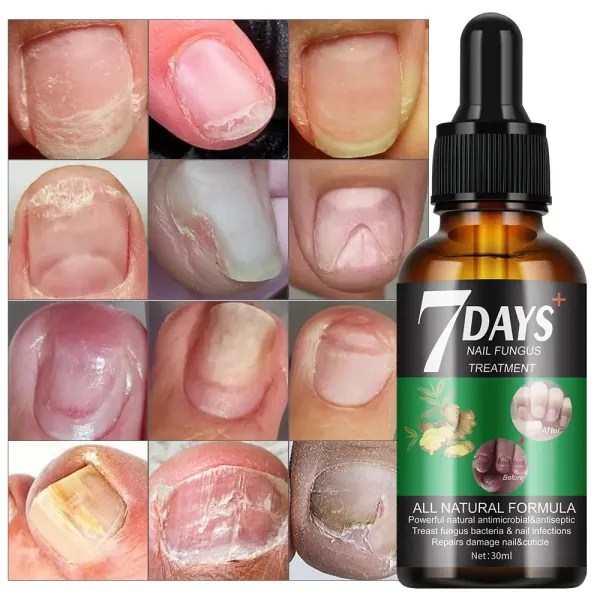 Nail Fungus Treatment Price in Pakistan – 7 Days Serum Review