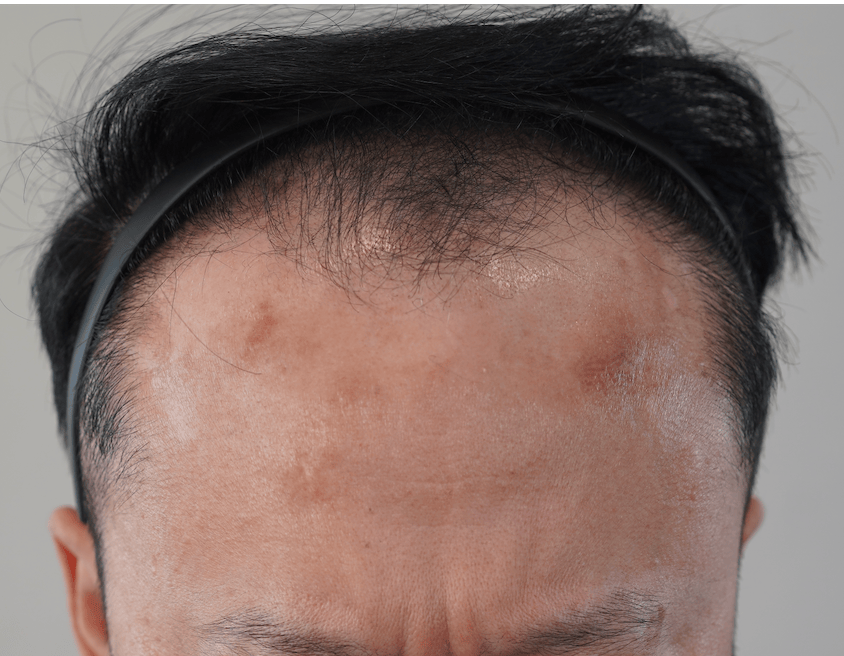 모발이식 남성 헤어라인 · 50대 남성 · 4000모 · 1년차 시술 전 각도 1 사진 — 사례 6586 (청담 모텐셜의원)