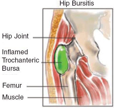 While the hard part may be. Hip Bursitis Moving With Ease Gold Coast Physiotherapy