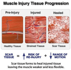 Muscle Injury-Scar Tissue Formation Process