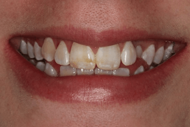 mild fluorosis example