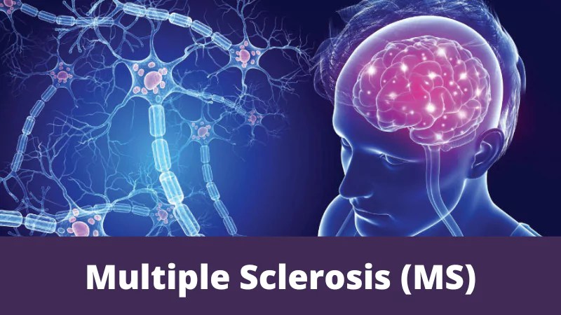 Multiple sclerosis (ms)