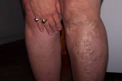 Varises | Muhlis3’s Weblog