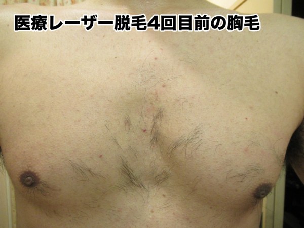 胸毛 鎖骨脱毛 Vネックシャツが着れる喜び ムダ毛がはみ出さない 写真 ムダ毛男の胸毛と腹毛の永久脱毛体験記ブログ