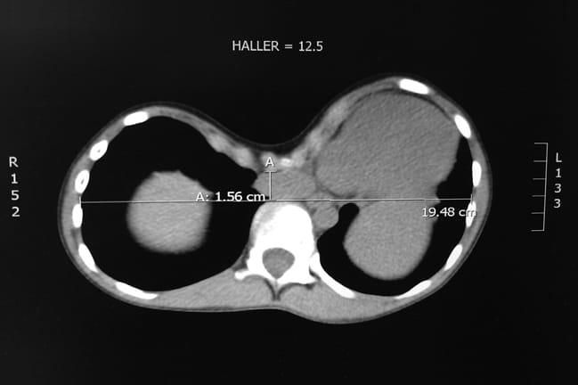 Haller index (hi) has emerged as the predominant way to identify patients for which surgical treatment is most appropriate. Pectus Guidelines Musc Health Charleston Sc