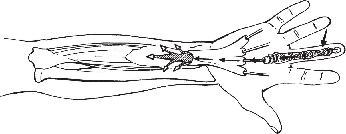 Acute Wrist and Hand Injuries | Musculoskeletal Key