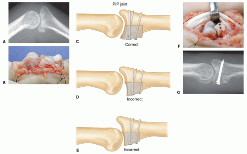Hemi Hamate Autograft Reconstruction Of Unstable Dorsal