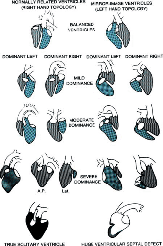 Single Ventricle | Musculoskeletal Key