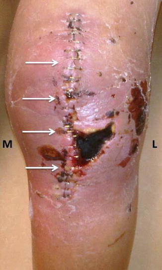 Complications After Revision Tkr Musculoskeletal Key