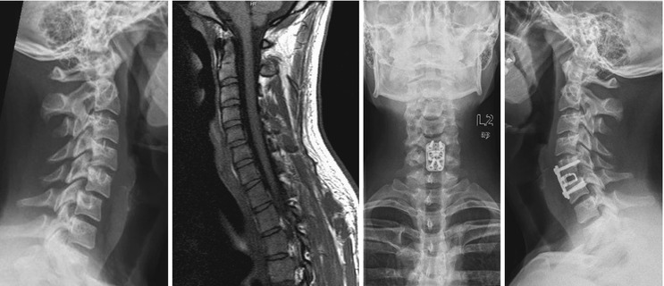 Cervical Spine Injuries | Musculoskeletal Key