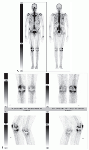 Diagnosing Infection | Musculoskeletal Key