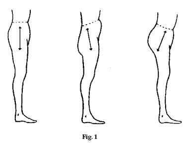 postures to know if you have anterior pelvic tilt