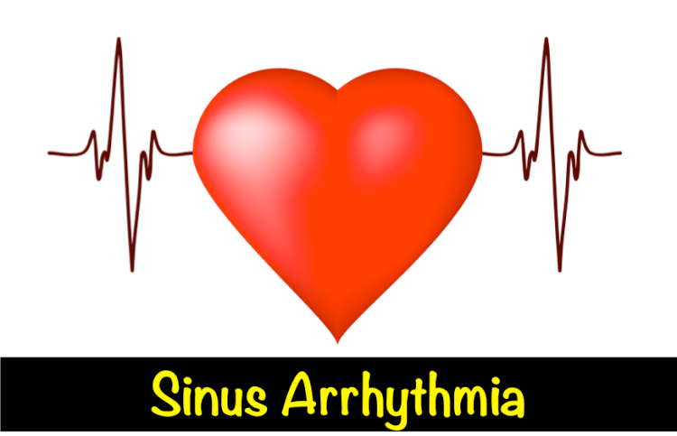 Sinus Arrhythmia What Is It