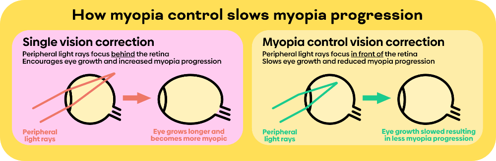 How do myopia control soft contact lenses work?