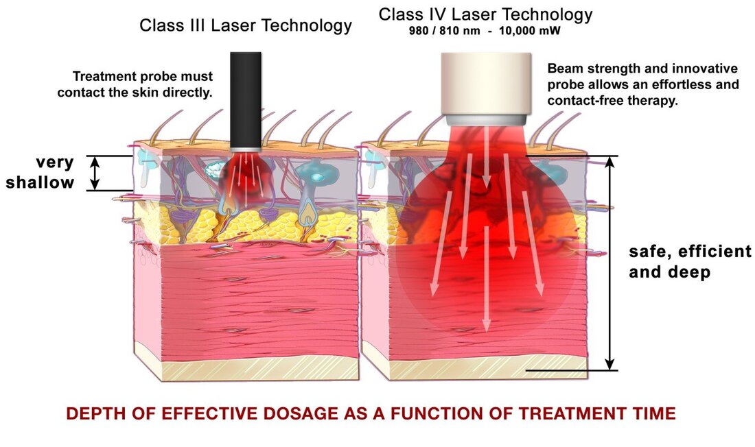 Class 4 laser therapy for pain