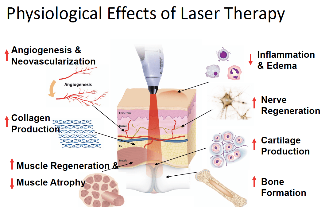 Class 4 BTL laser therapy for pain