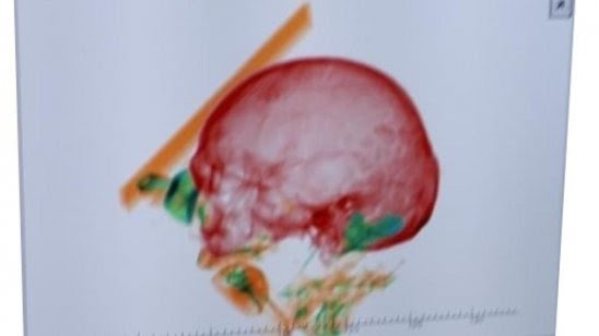 إمراة تحمل عظام زوجها في حقيبتها