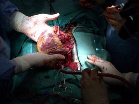 DOCTORS MAKE DEAD HEART WORK AGAIN