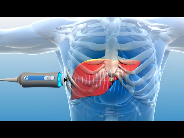 FibroScan device used for non-invasive liver stiffness testing
