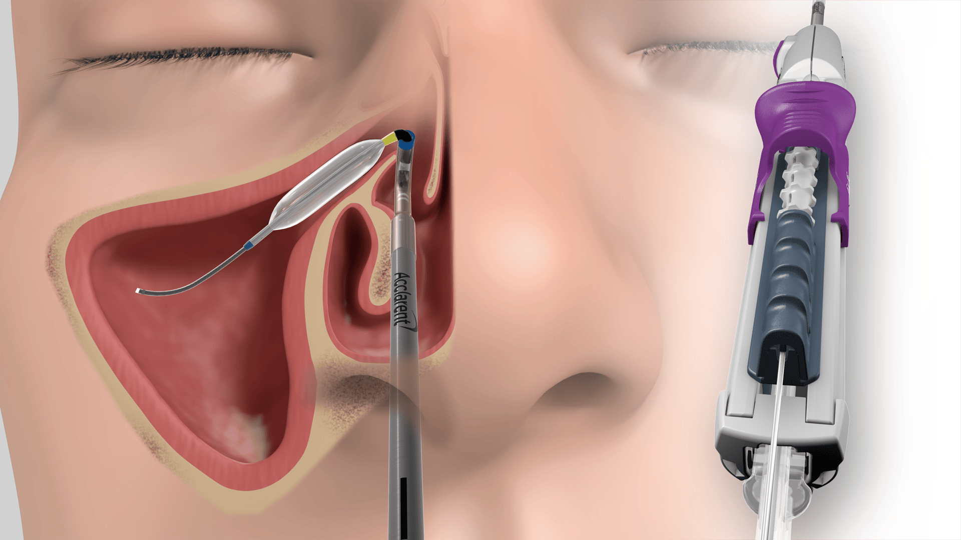 Sinuplasty Medical Device animation