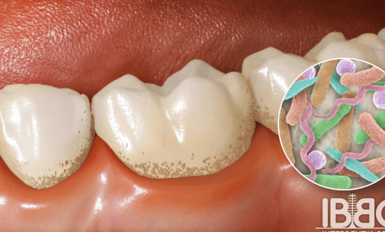 periodontal disease moa medical animation