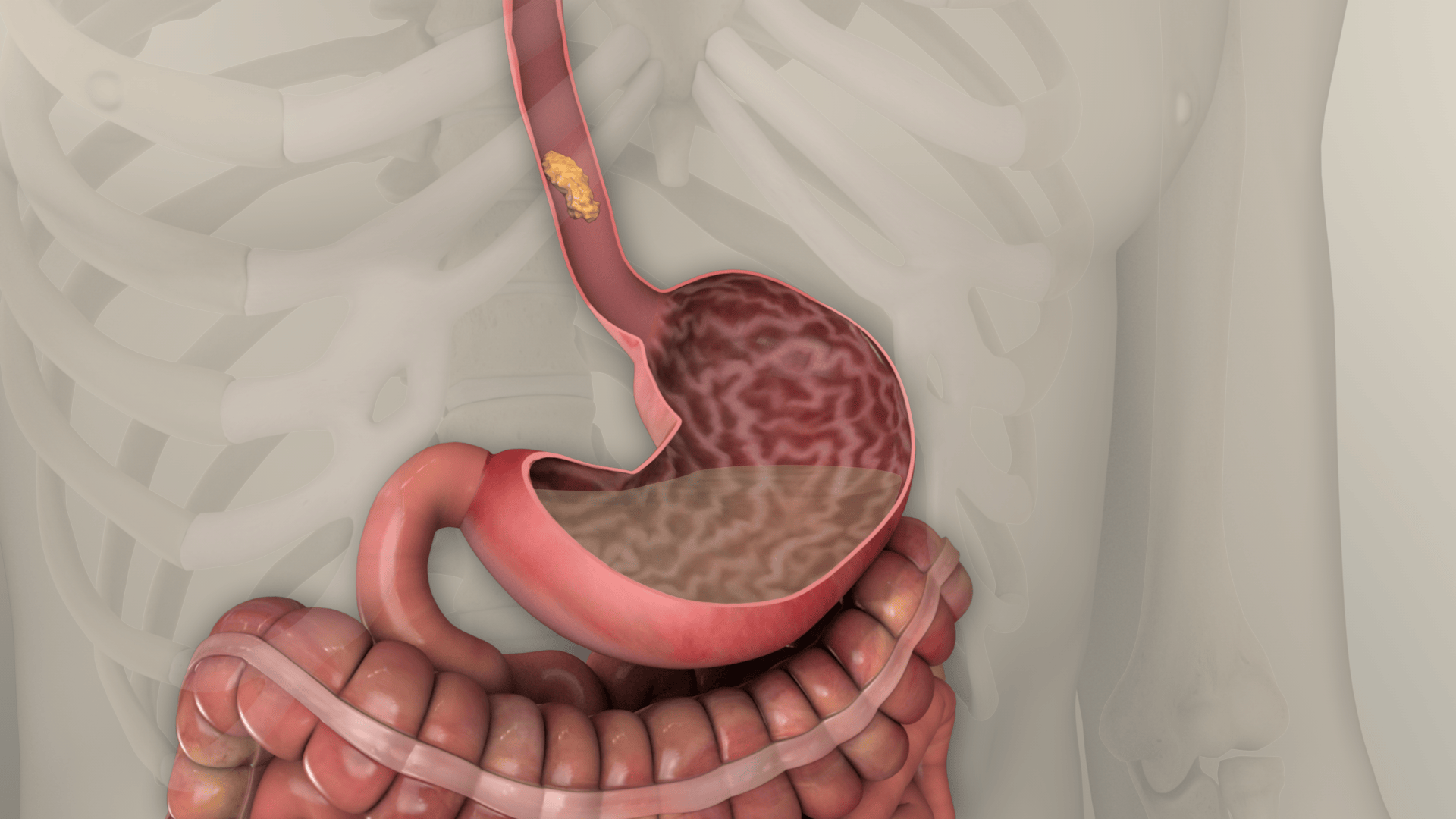 IBS Irritable Bowel Syndrome 3D moa medical animation
