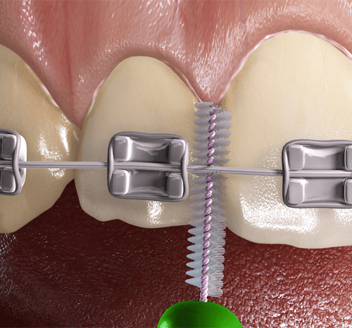 Interdental Brushes for Periodontal Disease Animation