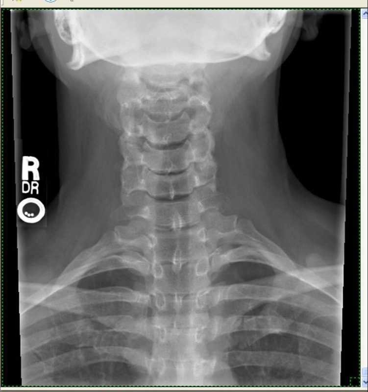 Feels like a broken neck