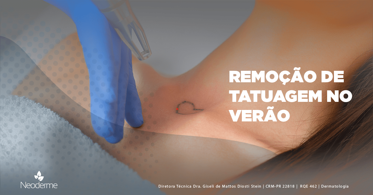 Cclinica de estetica para remover tatuagem em curitiba Remover Aquela Tattoo Que Voce Nao Up Estetica Avancada