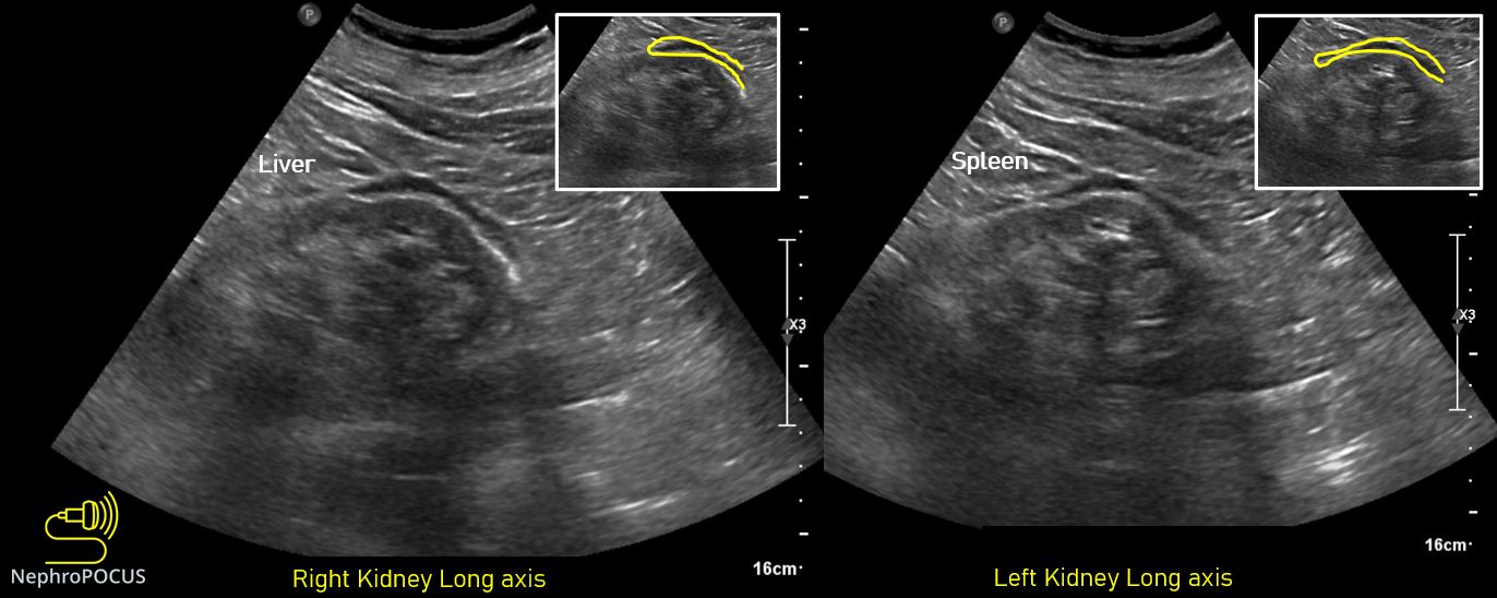 The ‘double line’ sign – NephroPOCUS