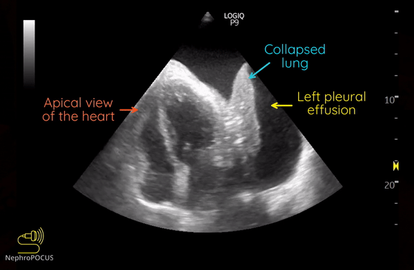 Pleural Effusion Visualized From The Apical Window Nephropocus