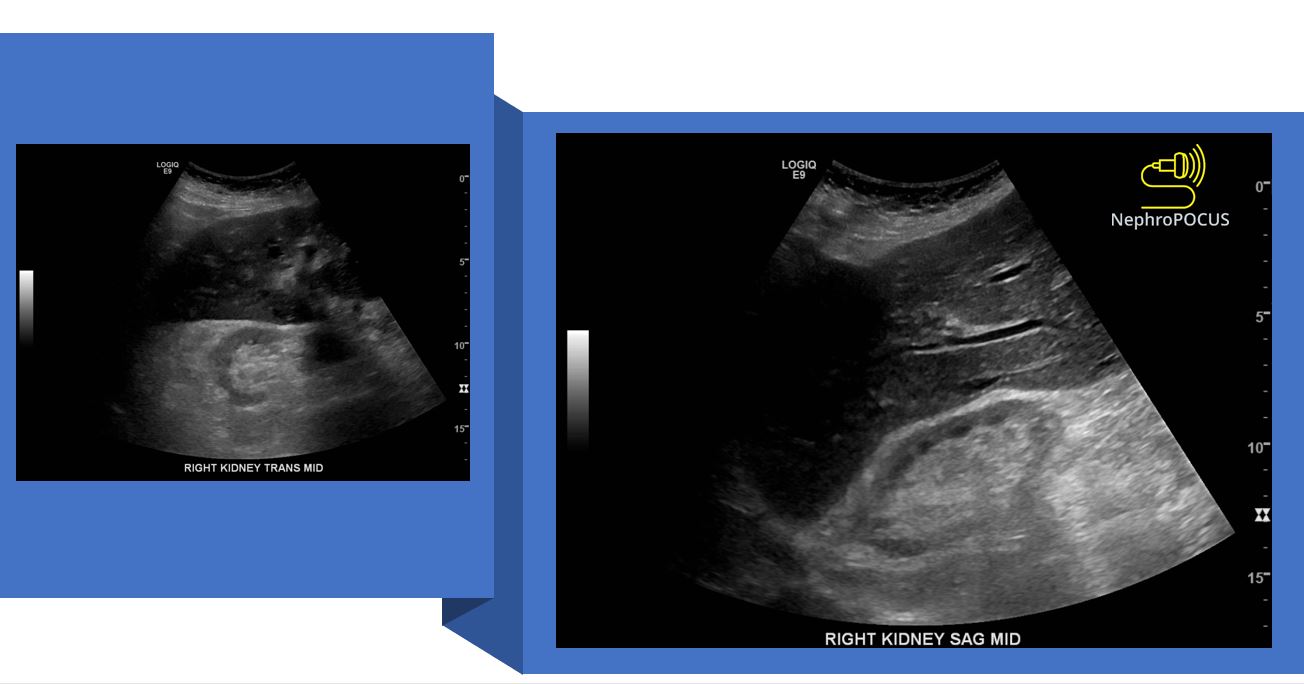 Increased renal cortical echogenicity does not always indicate chronic ...