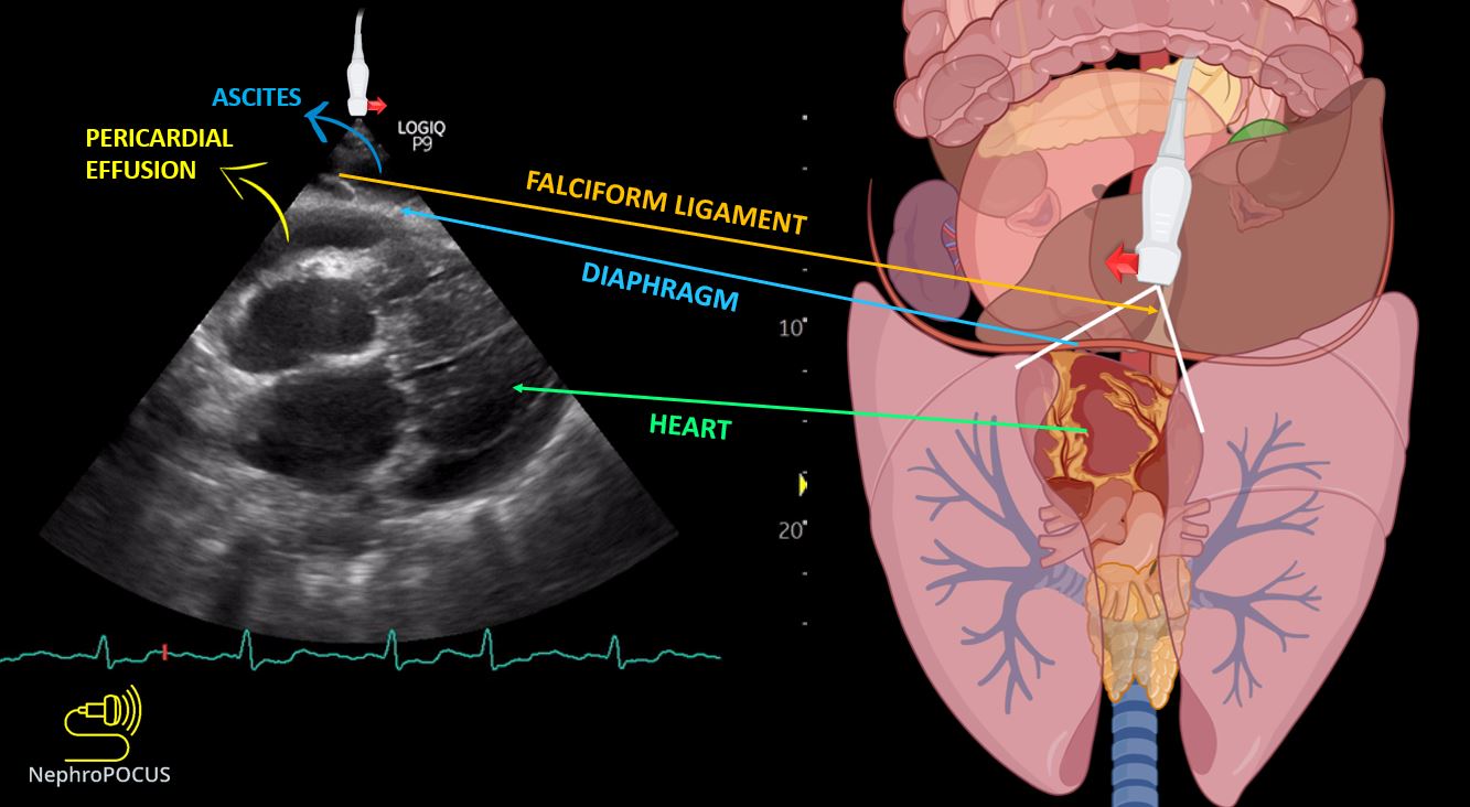 Fluid in the subcostal cardiac view – NephroPOCUS