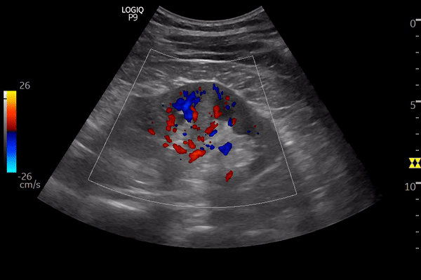 Dromedary hump – NephroPOCUS