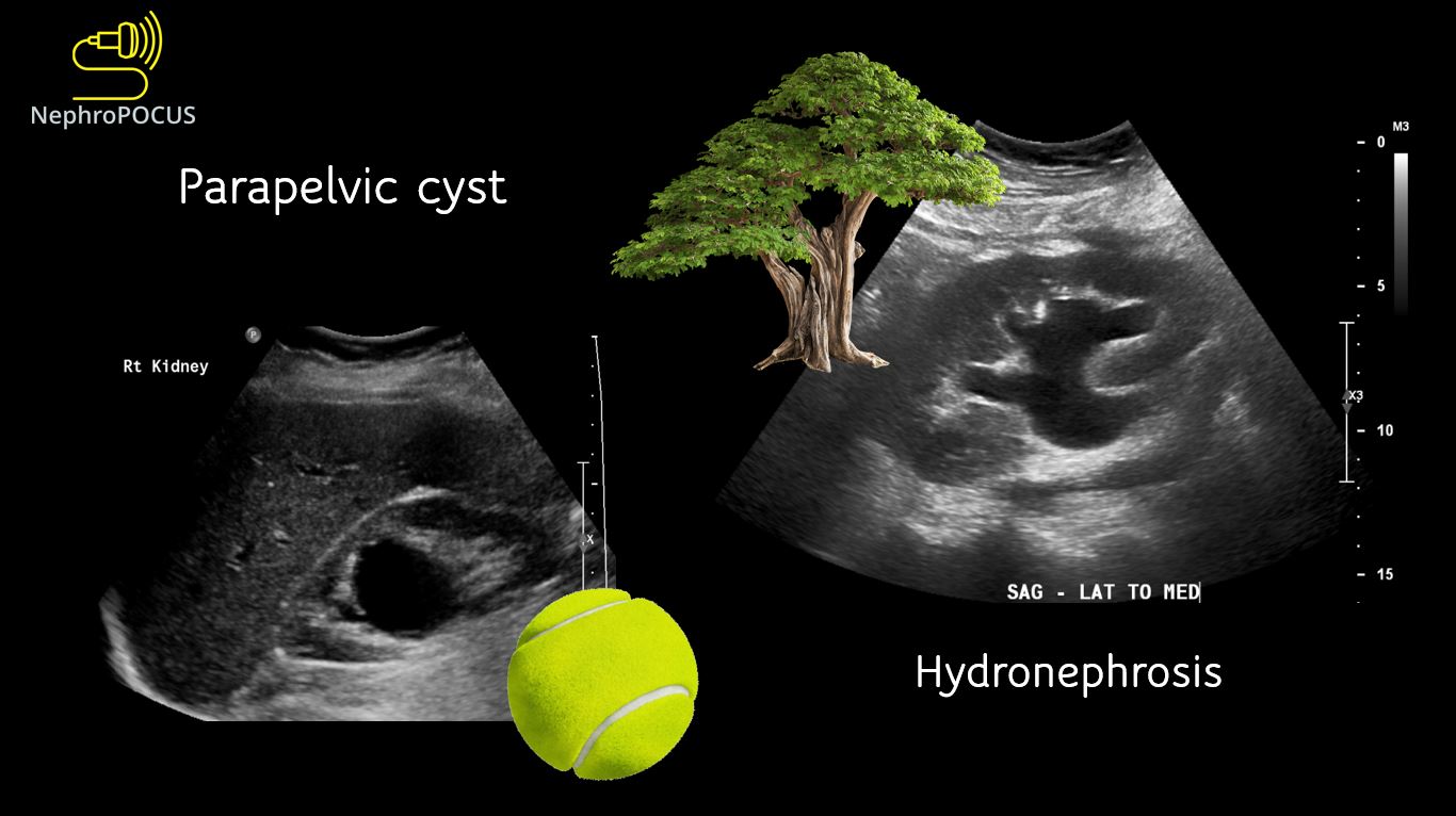 parapelvic-cyst-nephropocus