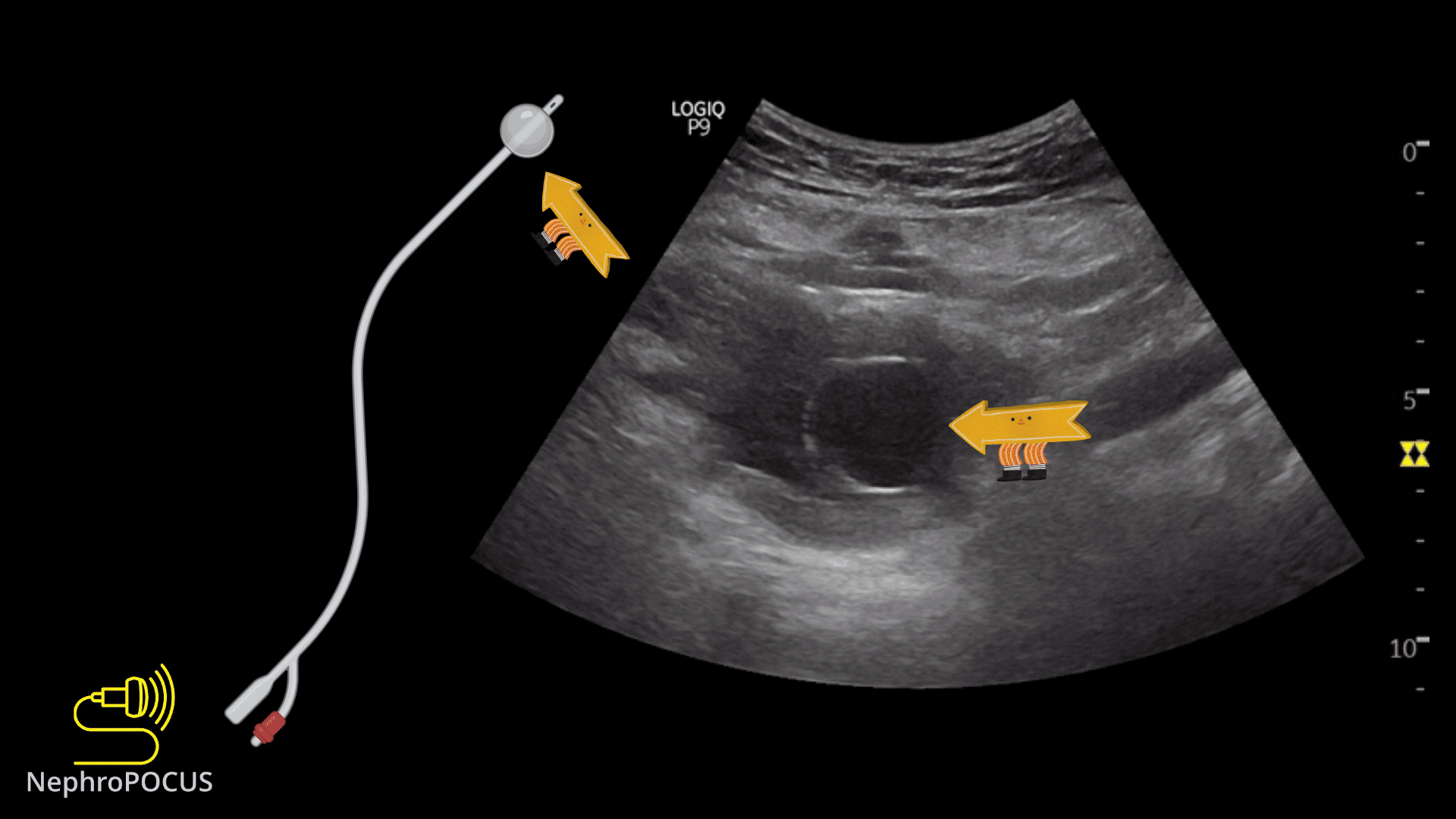 A case of hydronephrosis – NephroPOCUS