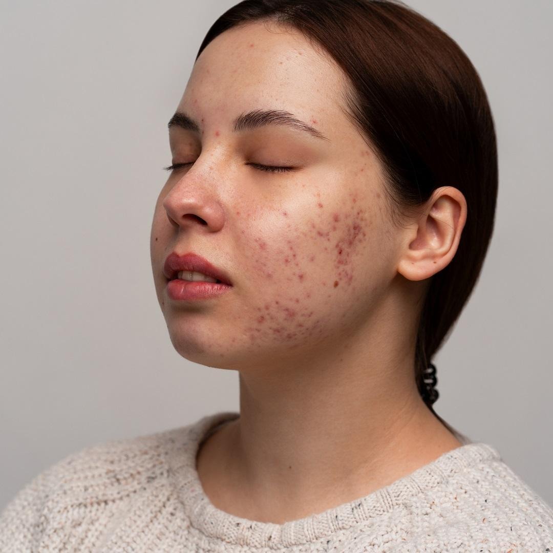 Does Pimple Treatment Work for Teen Acne
