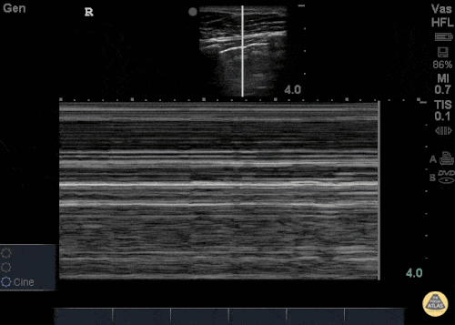images Pneumothorax Ultraschall nerdfallmedizin