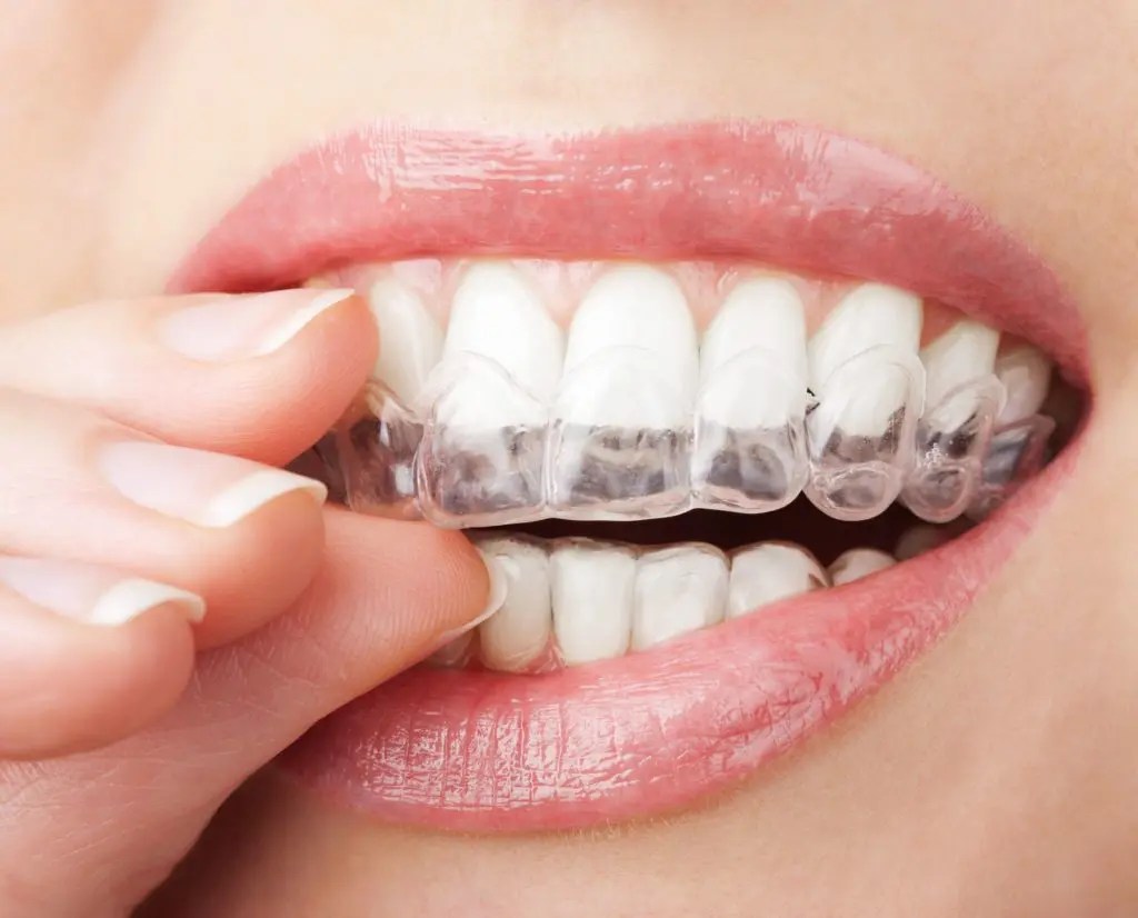 Invisalign. Nowoczesna technologia korekcji zgryzu bez widocznych aparatów ortodontycznych