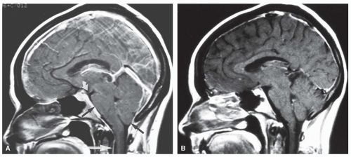 Brain Edema and Disorders of Intracranial Pressure | Neupsy Key