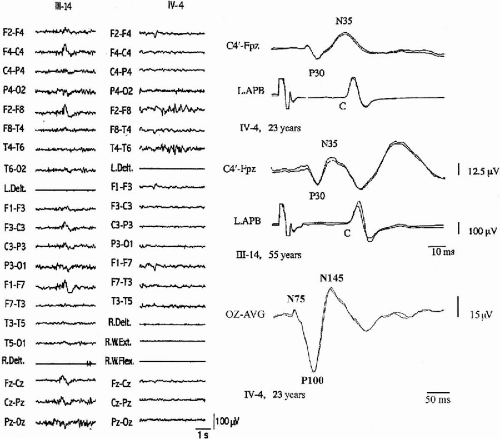 Autosomal Dominant Cortical Myoclonus and Epilepsy (ADCME) with Linkage