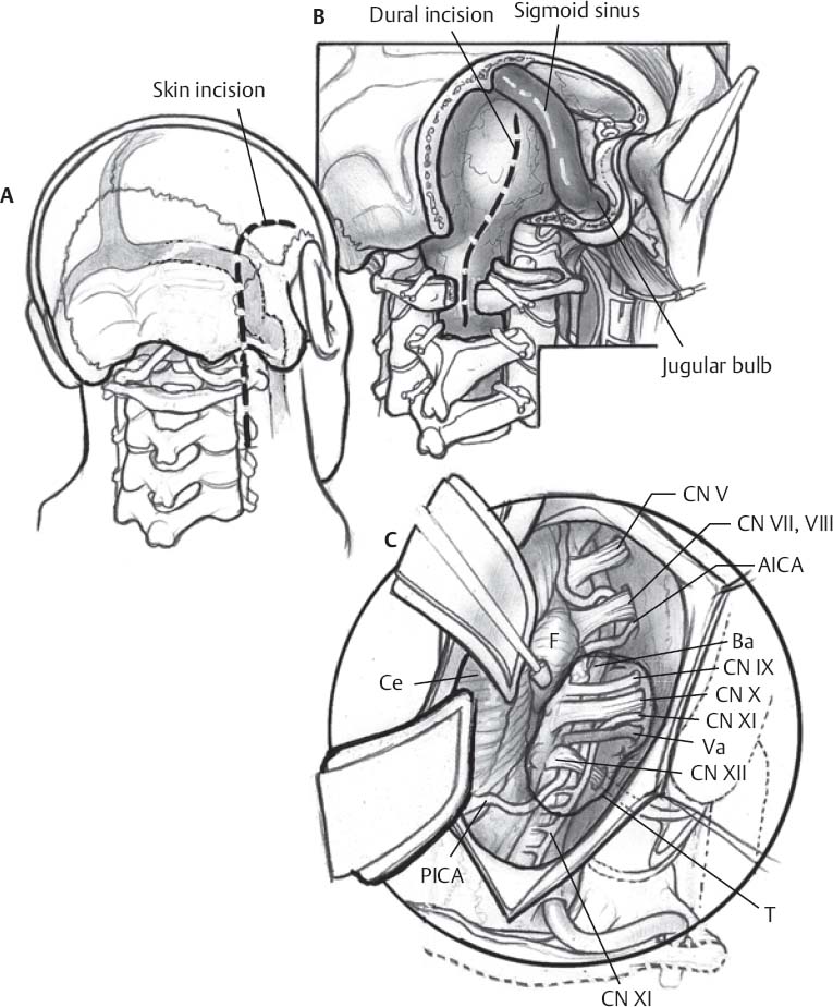 Far Lateral Approach | Neupsy Key