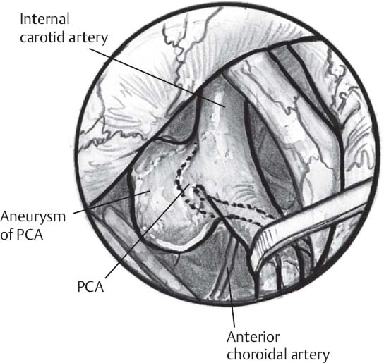 Posterior Communicating Artery Aneurysms | Neupsy Key