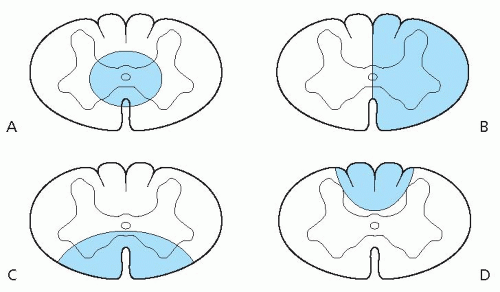 Lesions of the Spinal Cord | Neupsy Key
