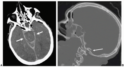 New Applications of Postmortem Neuroradiology in the Forensic ...