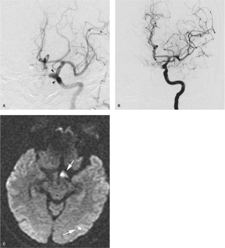 Intracranial Aneurysms, Diagnosis and Treatment | Neupsy Key