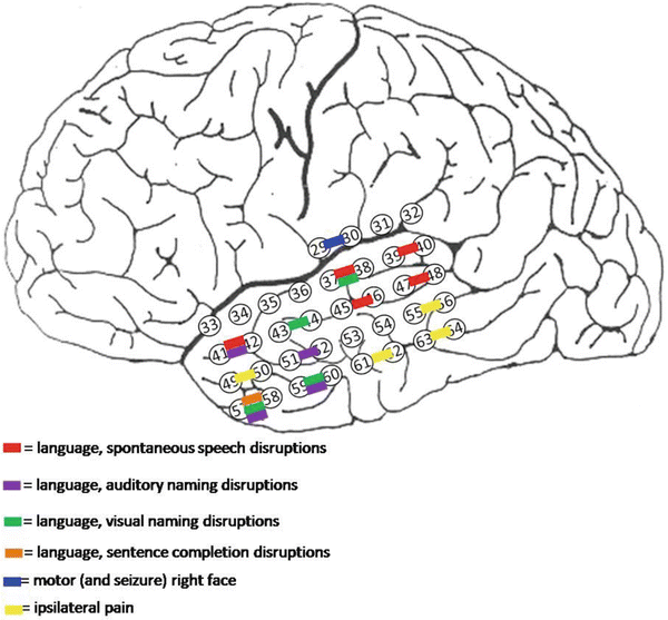 Electrocortical Mapping of Language | Neupsy Key